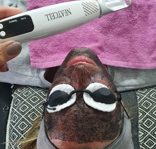 Hollywood Peel con carbon activado y laser Neatcell